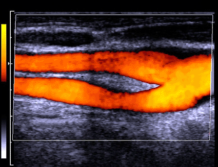 Image: Colored Doppler ultrasound scan of healthy blood flow through the junction of the common carotid artery (photo courtesy Zephyr / SPL).